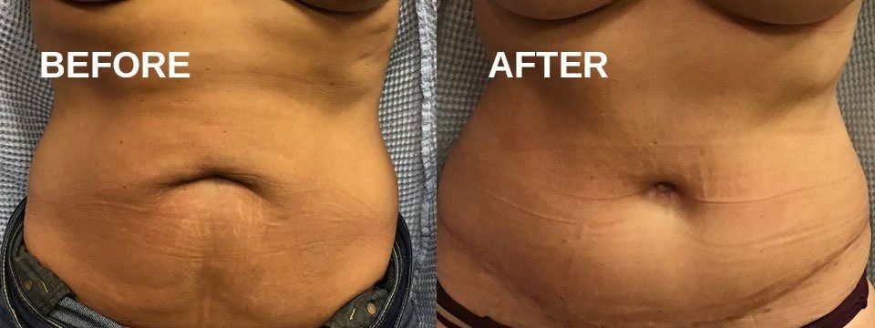 Side-by-side comparison: Before and after abdominal treatment, showing reduction in belly fat and improved skin appearance.