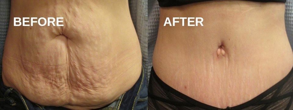 Side-by-side comparison of a person's abdomen, showing a change in appearance between 