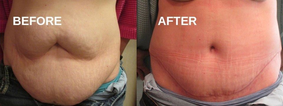 Comparison of a person's abdomen before and after a procedure. 