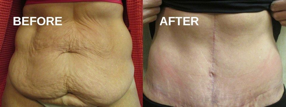 Before and after photos of a person's abdomen. The 'before' photo shows wrinkled skin, while the 'after' photo shows a smoother appearance.