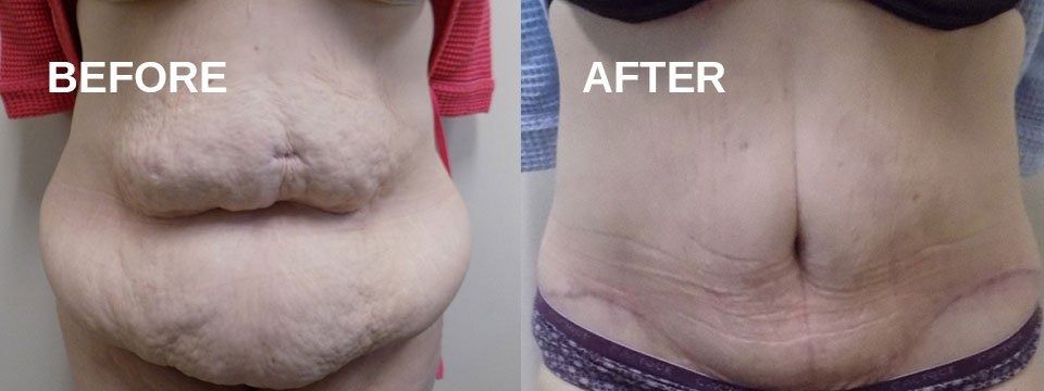 Side-by-side comparison of a person's abdomen, labeled 