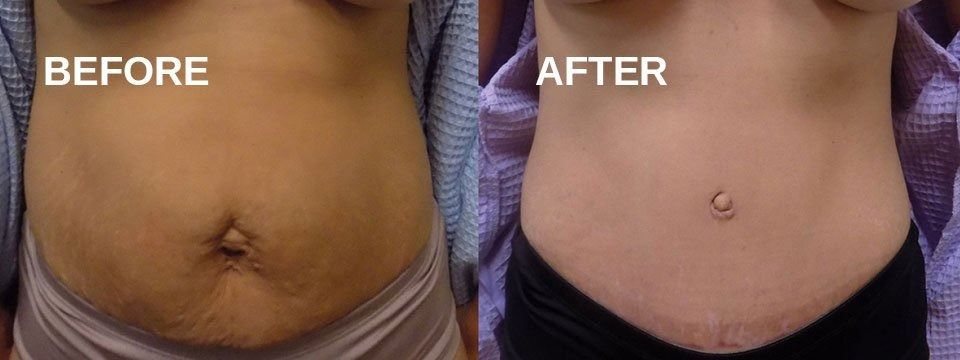 Side-by-side comparison of a person's abdomen, 