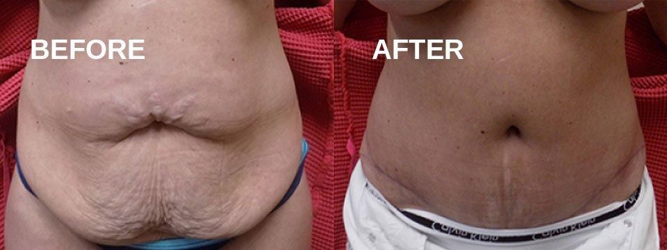 Side-by-side comparison of a person's abdomen, 