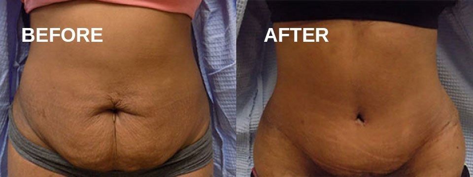 Side-by-side comparison of a person's abdomen, showing a 