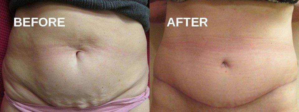 Comparison of a person's abdomen before and after a procedure; the 
