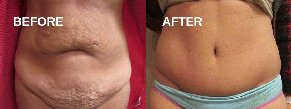 Abdomen, before and after treatment. 