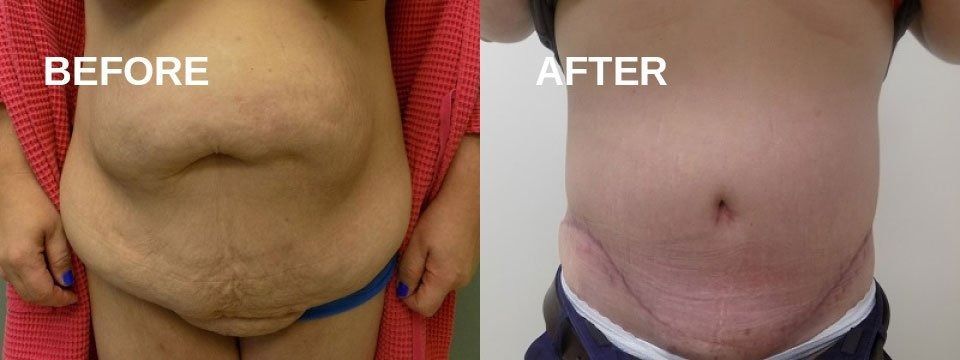 Before and after photo of a person's abdomen, showing the results of a tummy tuck procedure.