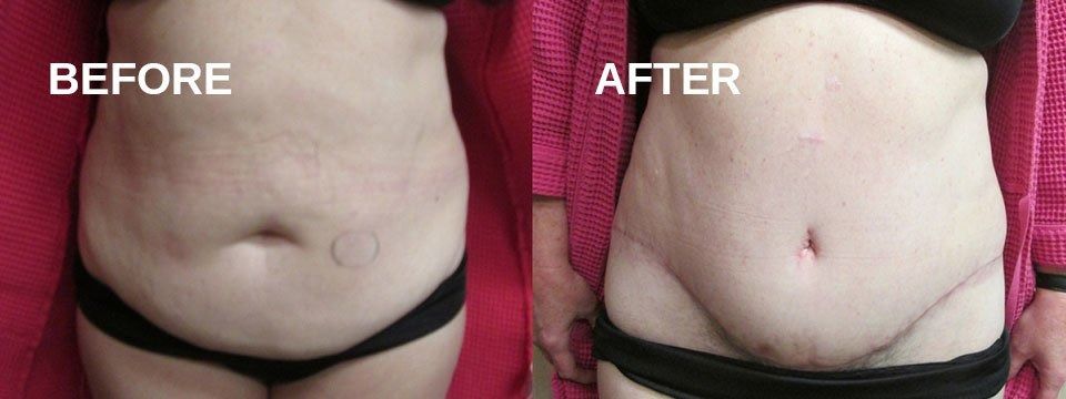 Side-by-side comparison of a person's abdomen, labeled 