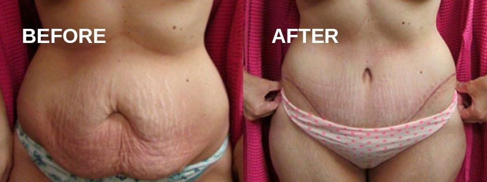Comparison of a woman's torso before and after a procedure. Shows a reduction in abdominal fat and skin folds.