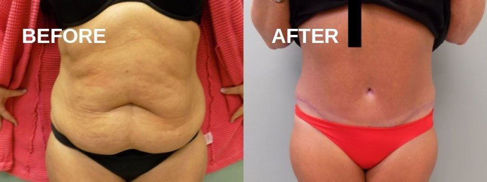 Side-by-side comparison of a person's abdomen, before and after a procedure. 