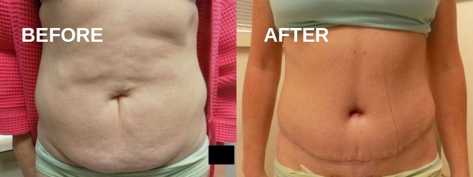 Side-by-side comparison of a person's abdomen, 