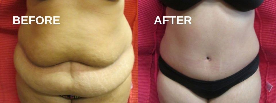 A before-and-after comparison of a person's abdomen, showing a visible reduction in fat and skin.