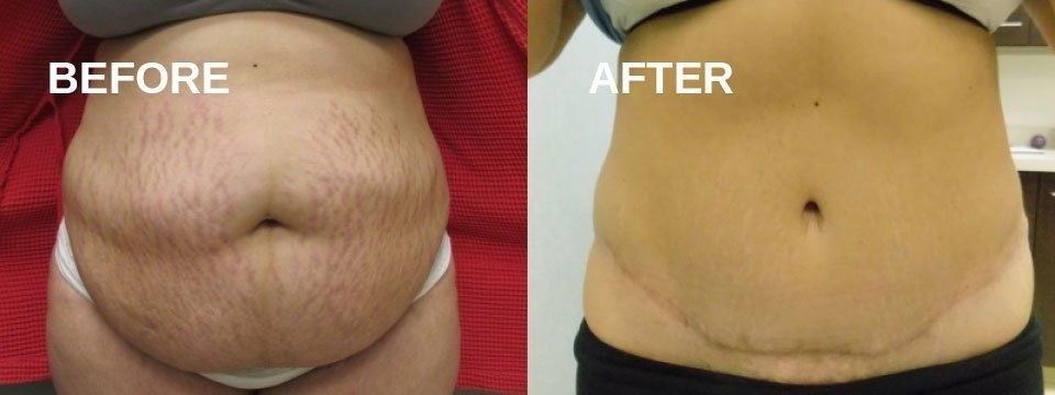 Before and after comparison of an abdomen. The 