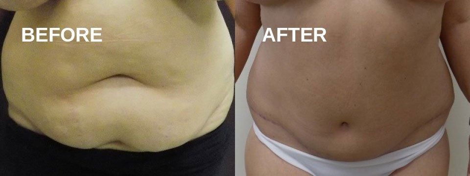 Abdomen before and after. Skin appears smoother, less fat. Before shows folds, discoloration.