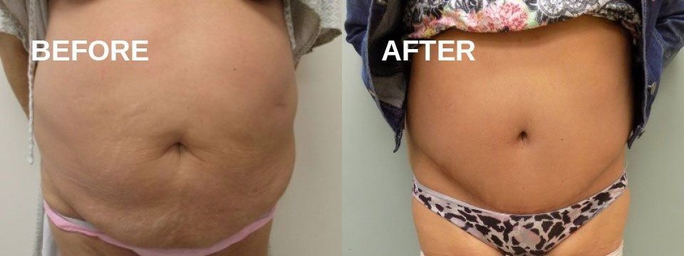 Side-by-side belly shots. Before: stretched skin, pink underwear. After: tighter skin, patterned underwear.