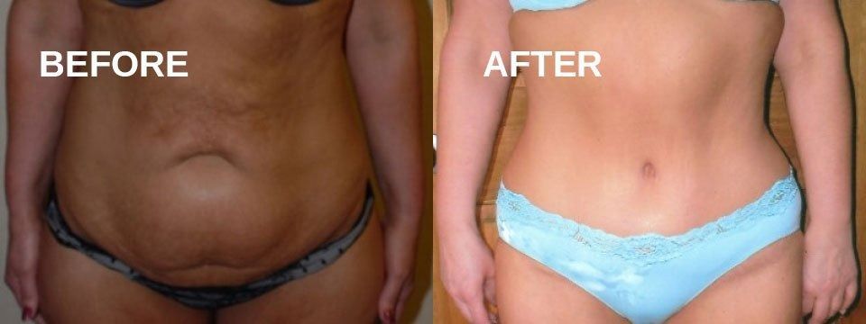 Side-by-side comparison: Before and After abdomen transformation.
