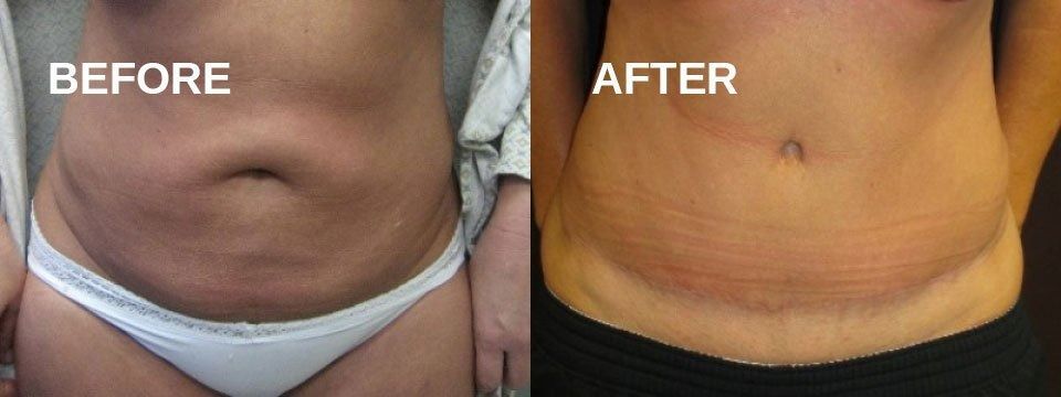 Side-by-side belly shots: 