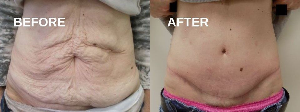 Abdomen before and after a cosmetic procedure. The 