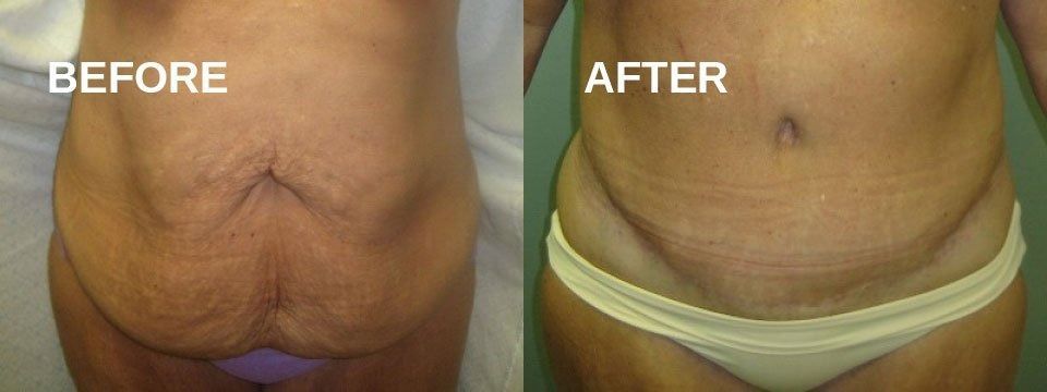 Before and after view of a person's abdomen, showing a surgical scar and smoother skin.