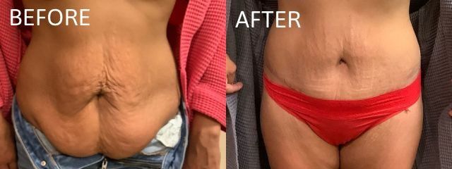 Side-by-side comparison of a person's abdomen before and after a procedure, showing skin reduction and reshaping.