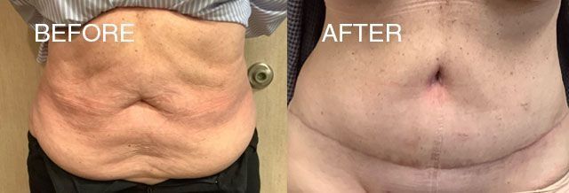 Side-by-side belly comparison: before (wrinkled skin) and after (smoother skin) a cosmetic procedure.