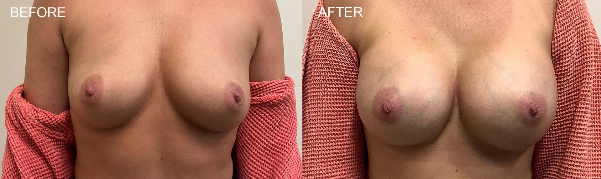 Before-and-after side view of a torso in a red top showing breast enhancement results.