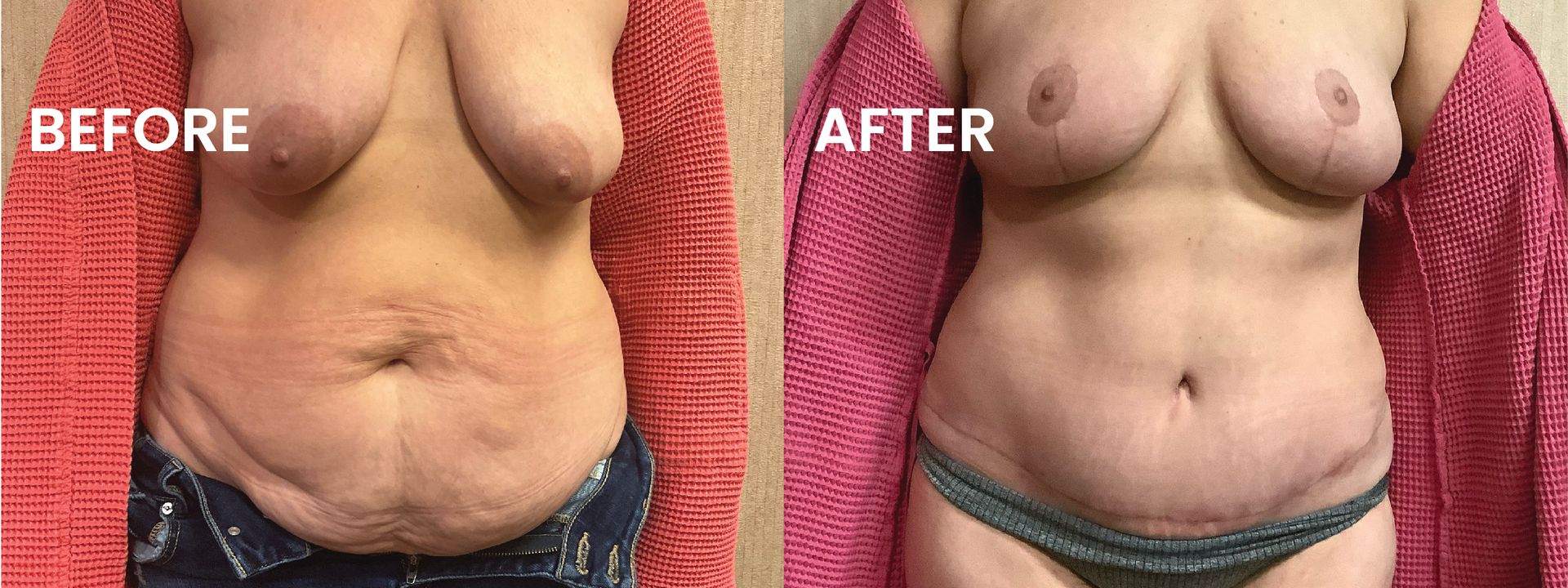 Split image labeled BEFORE and AFTER showing a torso with reduced abdominal fat and a flatter stomach.