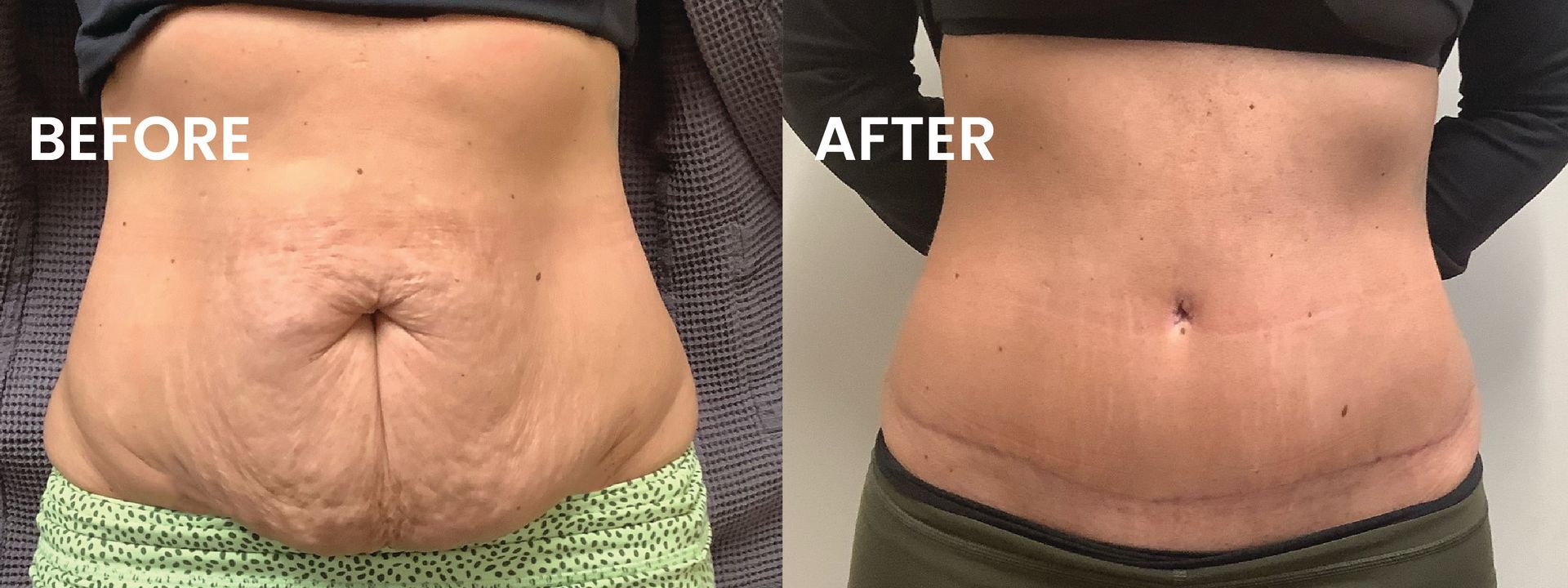 Before-and-after comparison of a torso, showing a looser abdomen on the left and a flatter abdomen on the right.