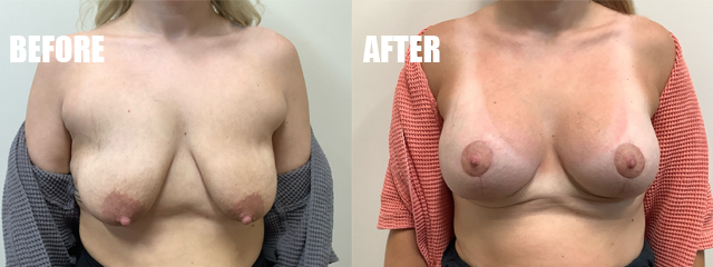 Side-by-side before and after torso photo showing a lighter tan on the right.