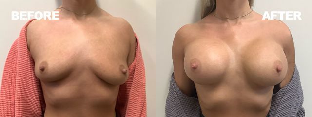 Side-by-side before and after torso photo, showing a woman’s chest in red and gray wraps.