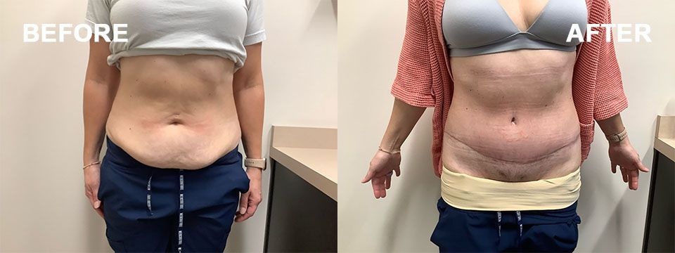 Before-and-after comparison showing the torso of a person before and after a surgical abdominoplasty procedure.