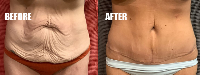 Before-and-after comparison of a torso, showing loose skin on the left and a smoother abdomen on the right.