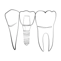 Learn More About Implant Solutions Dental implants
