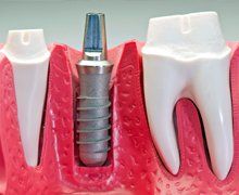 Dental implant