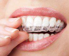 Invisalign