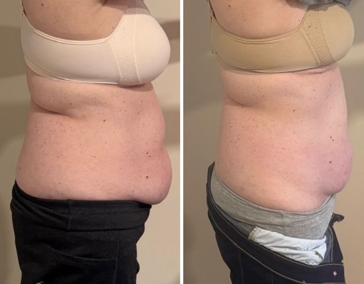 Side-by-side comparison of a torso. Before photo shows a bulge; after photo shows a flatter abdomen.