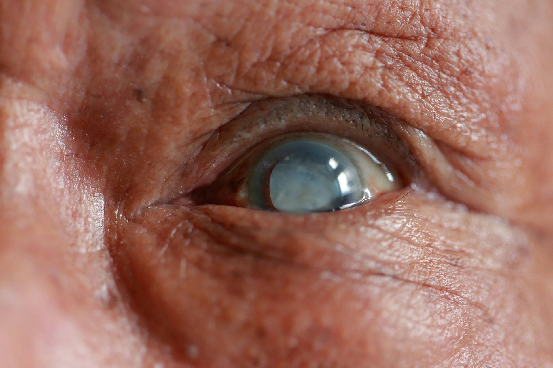 Cataract correction