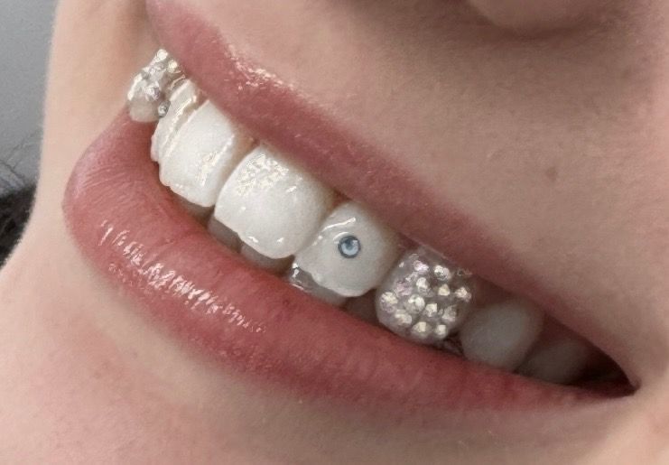 bedazzled-tooth-gems