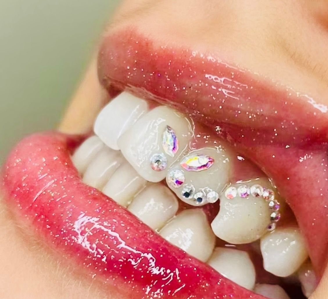bedazzled-tooth-gems