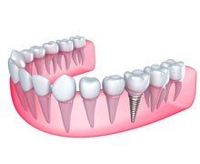Dental implants icon