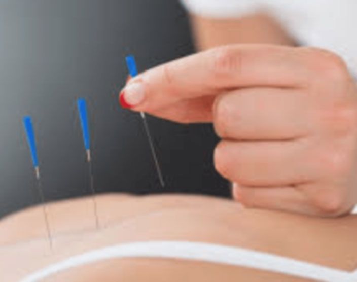 Hand placing acupuncture needles into skin, with blue-handled needles visible