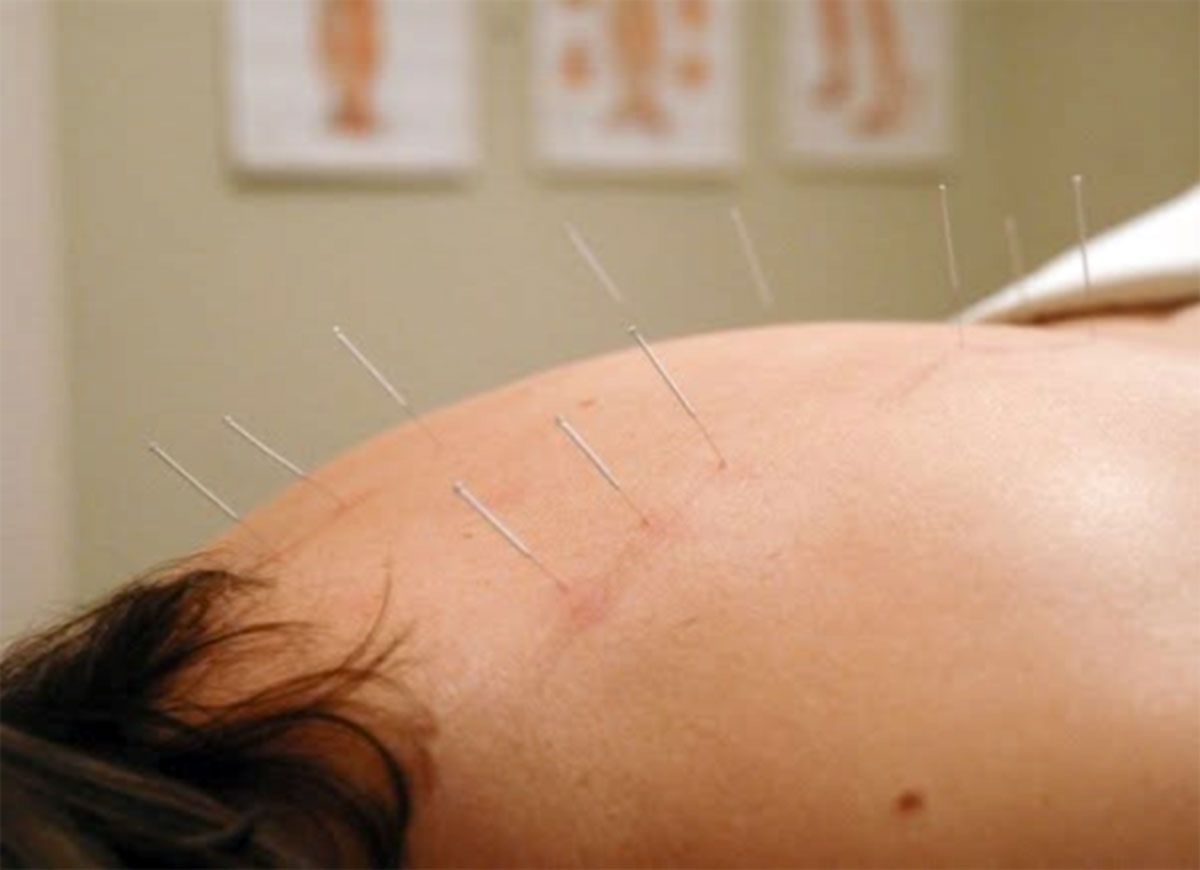 Close-up of acupuncture needles inserted into a person’s back