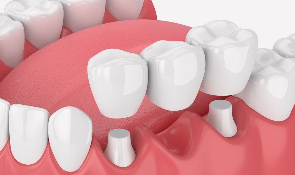 Dental Crowns