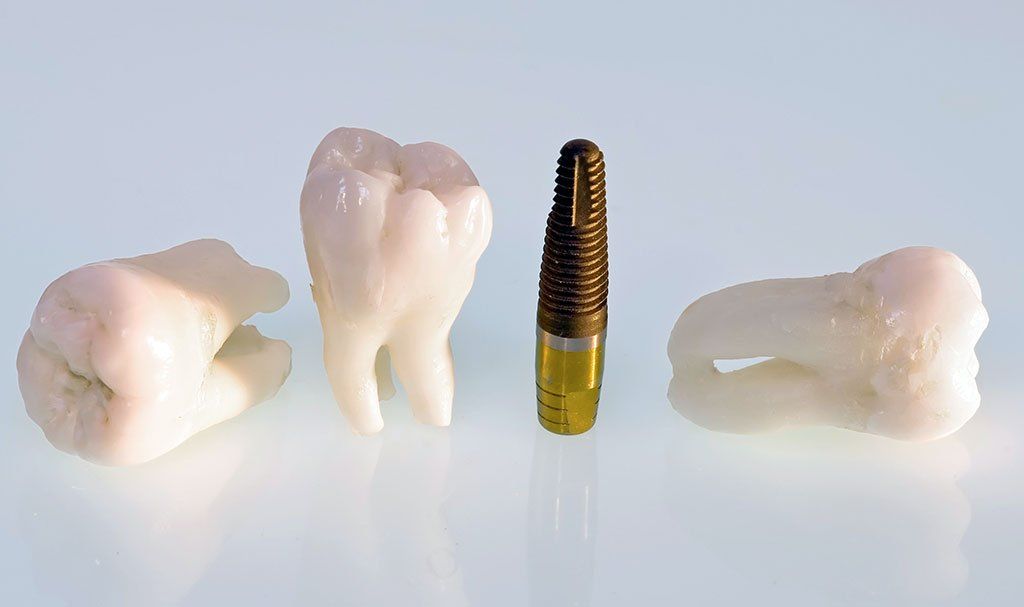 Dental Implants
