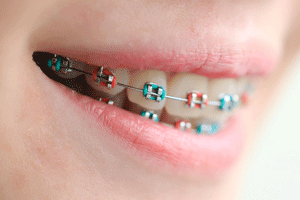 Memory Wire Braces  Pacific Dental Care