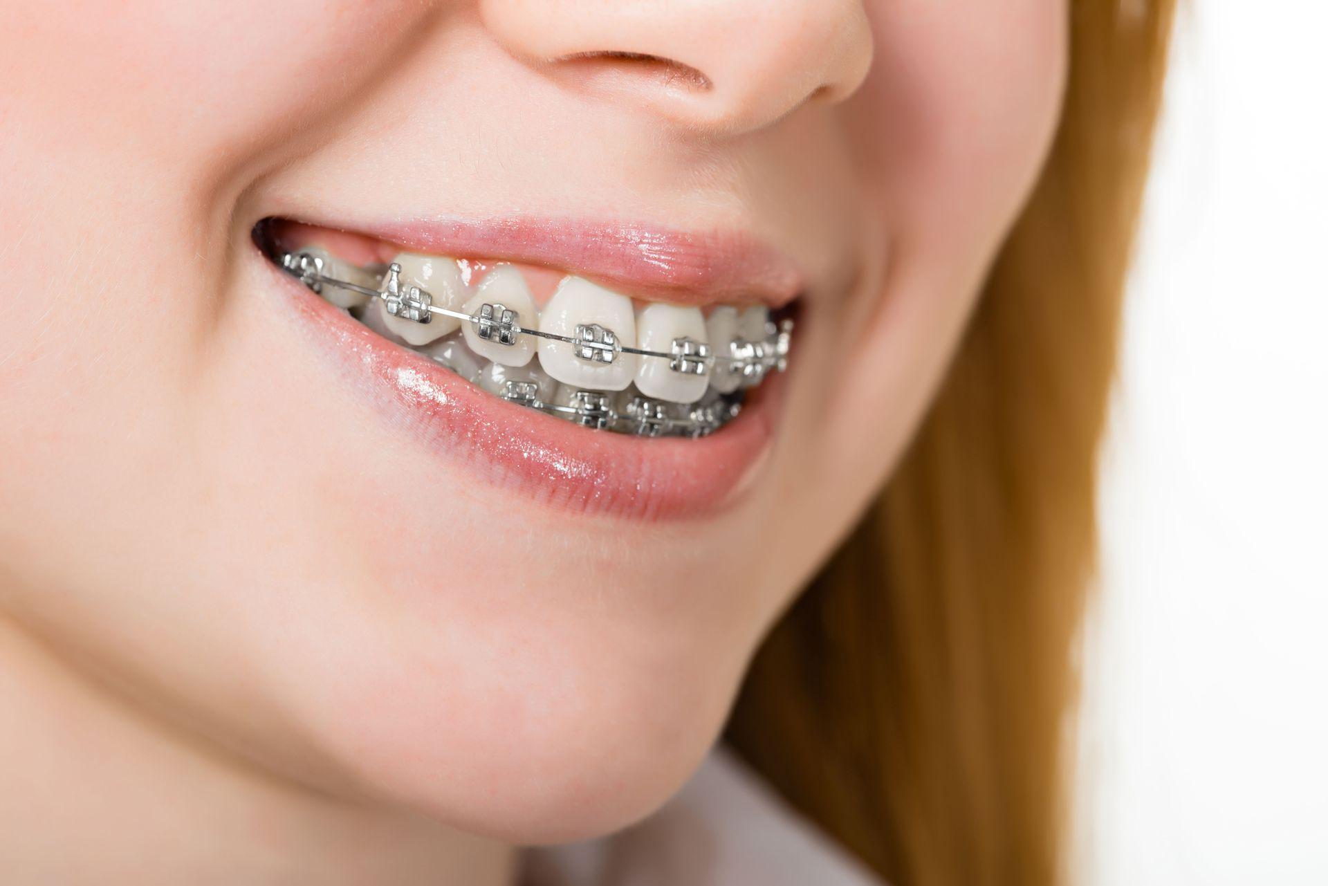 Close-up of a smiling mouth with silver braces on the teeth