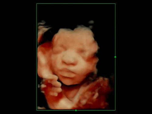 4-D Ultrasound Imaging