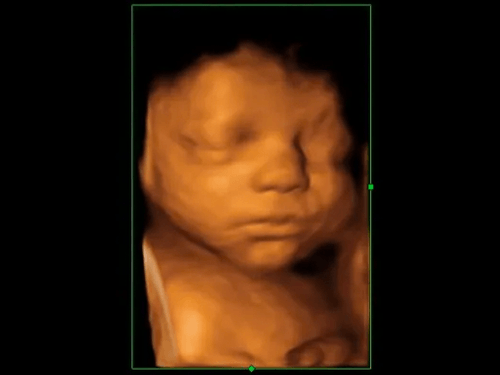 4-D Ultrasound Imaging