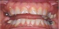 Veneers & Crowns Before