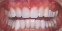 Veneers & Crowns After